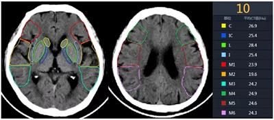The prognostic value of ASPECTS in specific regions following mechanical thrombectomy in patients with acute ischemic stroke from large-vessel occlusion